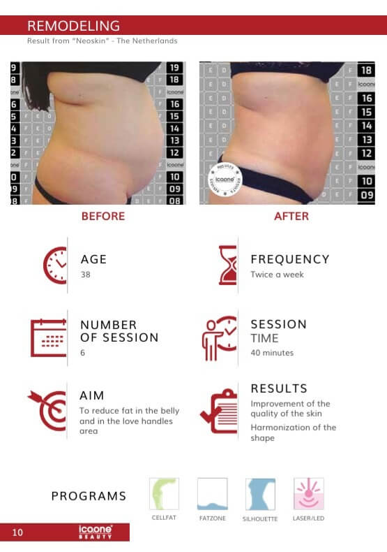 Body Contouring Bauch vorher nachher