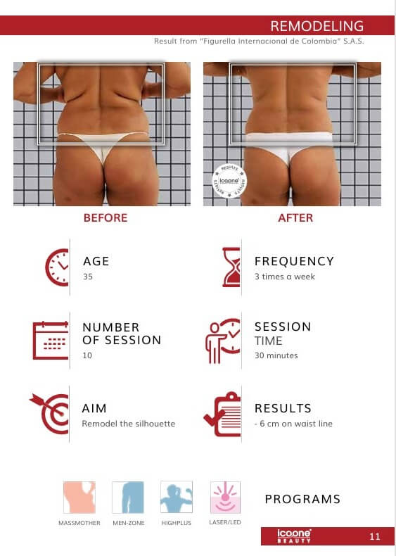 icoone Body Contouring Vorher Nachher