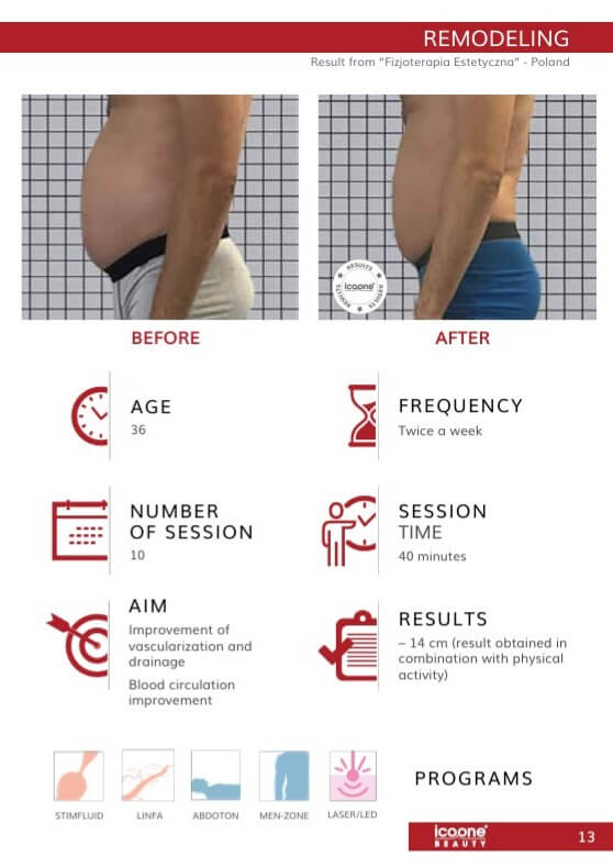 icoone Body Contouring Vorher Nachher Zürich