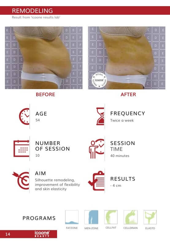 icoone Body Contouring Vorher Nachher Zürich