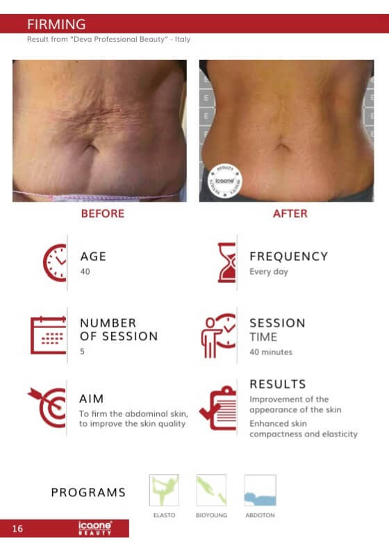 Hautstraffung Bauch vorher nachher – 5 Sitzungen