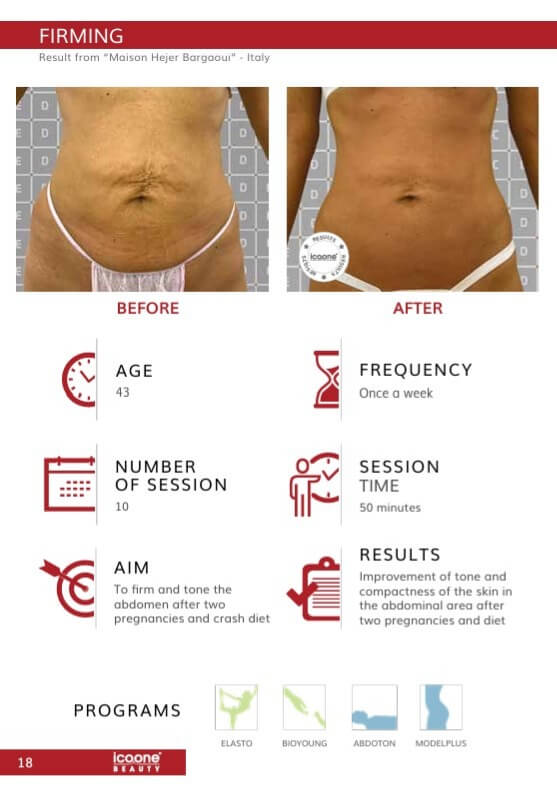 Bauch nach 2 Schwangerschaften vorher nachher