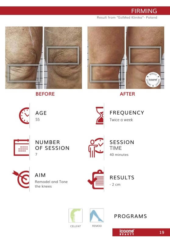 Hautstraffung Kniebereich vorher nachher