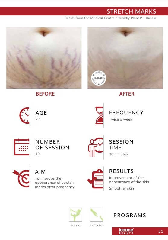 icoone Dehnungsstreifen Vorher Nachher Zürich