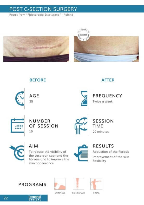 icoone Narbenbehandlung Vorher Nachher