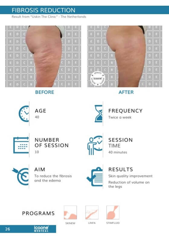 Лимфодренаж до и после – уменьшение фиброза