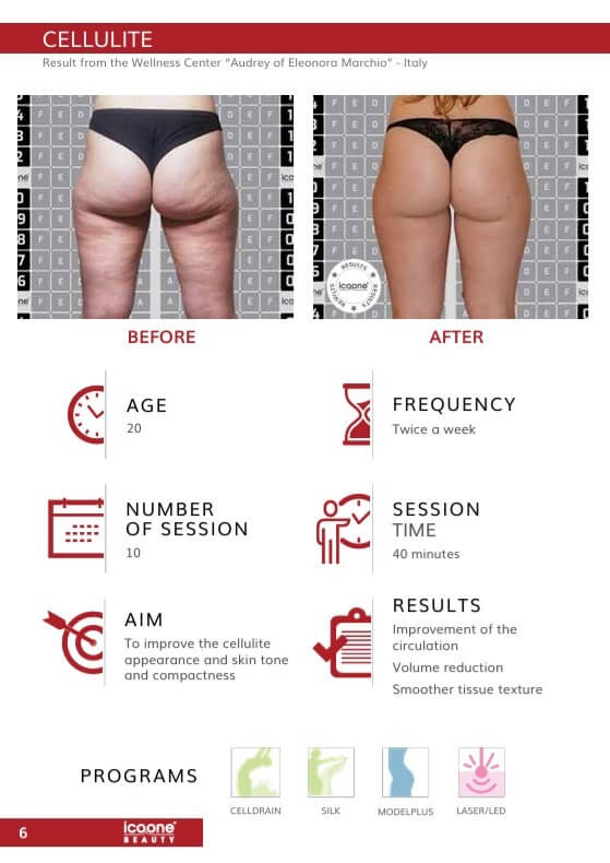 icoone Cellulite Vorher Nachher