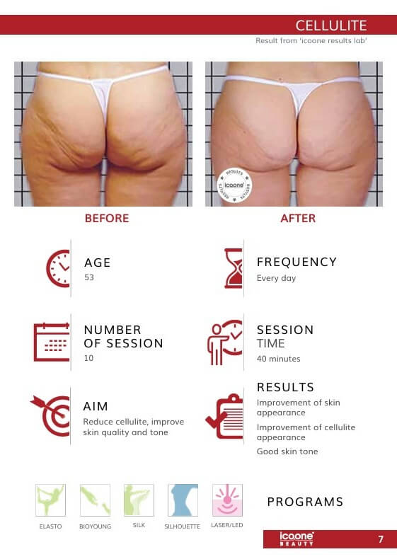 Cellulite Behandlung vorher nachher – tägliche Sitzungen