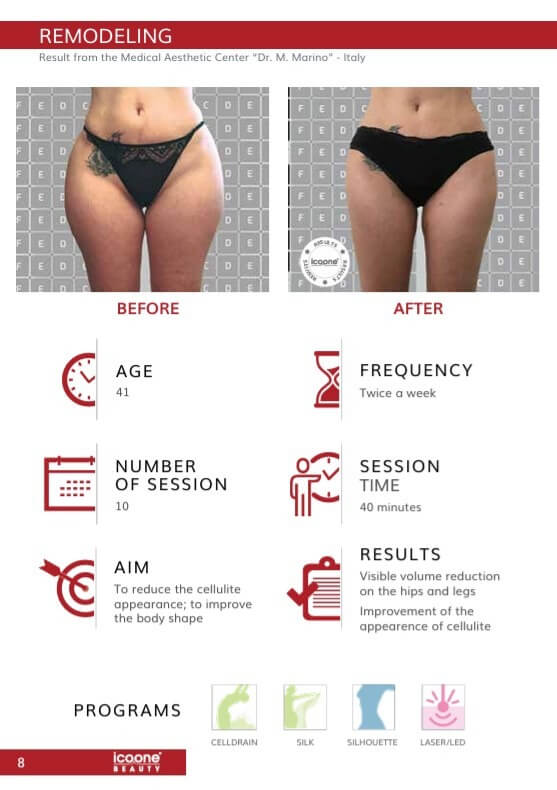 icoone Body Contouring Vorher Nachher