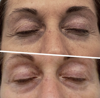 icoone® Face Defatiguing – Vorher/Nachher, 50 Jahre, 5 Sitzungen