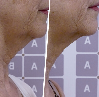 Anti-Aging Remodelling vorher nachher