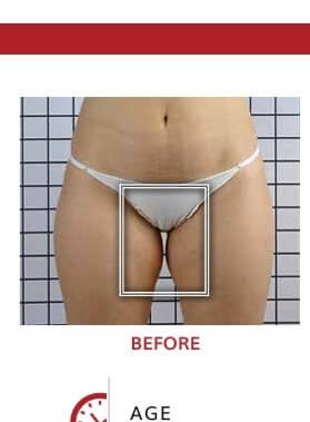 Cellulite nach 10 icoone® Sitzungen