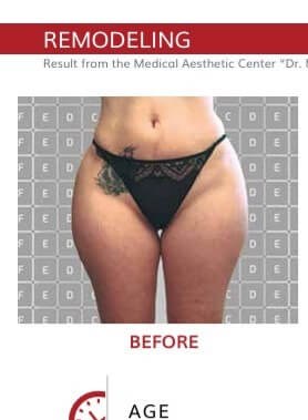 Cellulite nach 5 icoone® Sitzungen