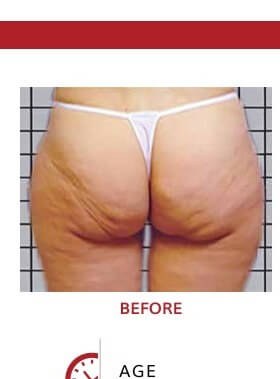 Cellulite Oberschenkel vor icoone® Behandlung